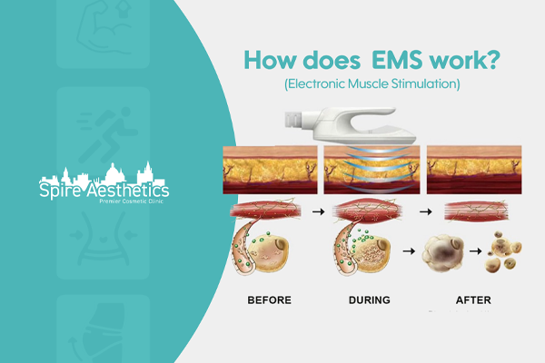 EMS treatment for post pregnancy weight loss treatment Llanelli