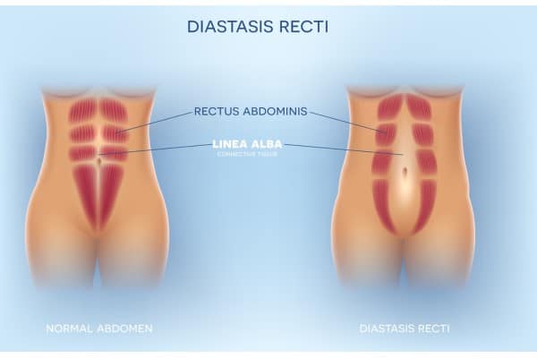 What Non-Surgical Options Are Available for Diastasis Recti Llanelli?