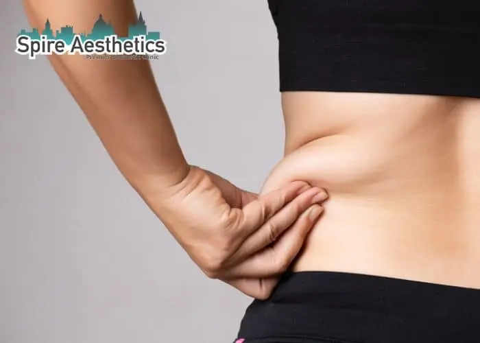 Image of woman pinching fat on their hips Llanelli. Fat Freezing treatment 
