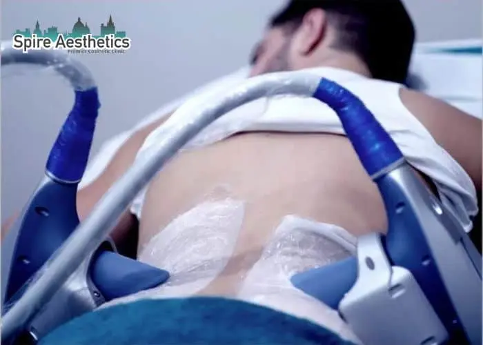 Man having fat freezing treatment done on love handles before a competitions Llanelli to create a sculpted look.