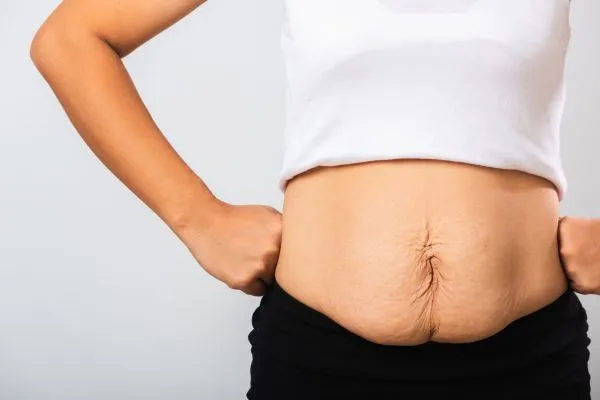 Image of a woman's stomach after weight loss with sagging skin following a gastric band Llanelli