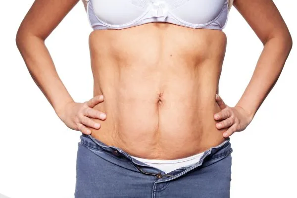 sagging skin on woman's stomach after weight loss injections Llanelli