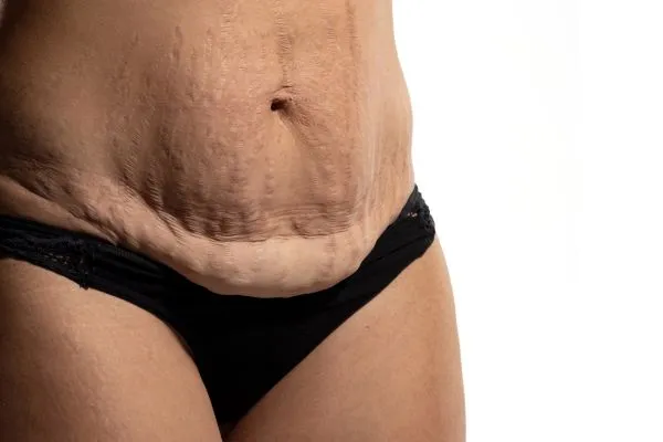 Image of womans stomach after weight loss injections Llanelli showing saggy skin
