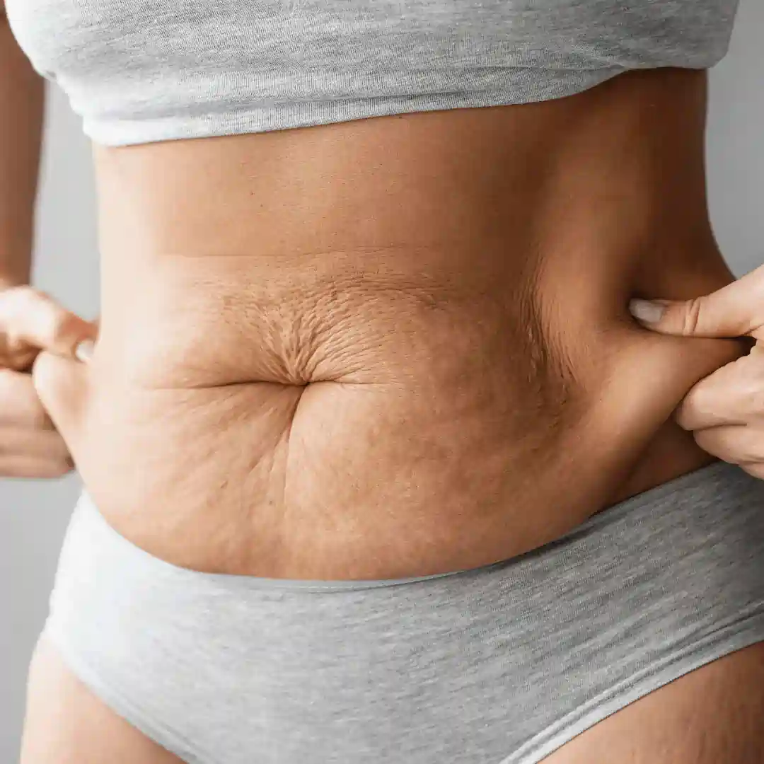 Is It Normal to Have Loose Skin After Pregnancy Llanelli?