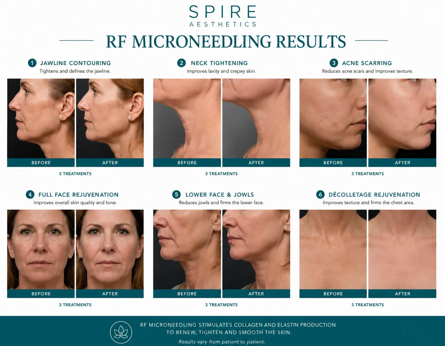RF Microneedling Skin tightening Llanelli results