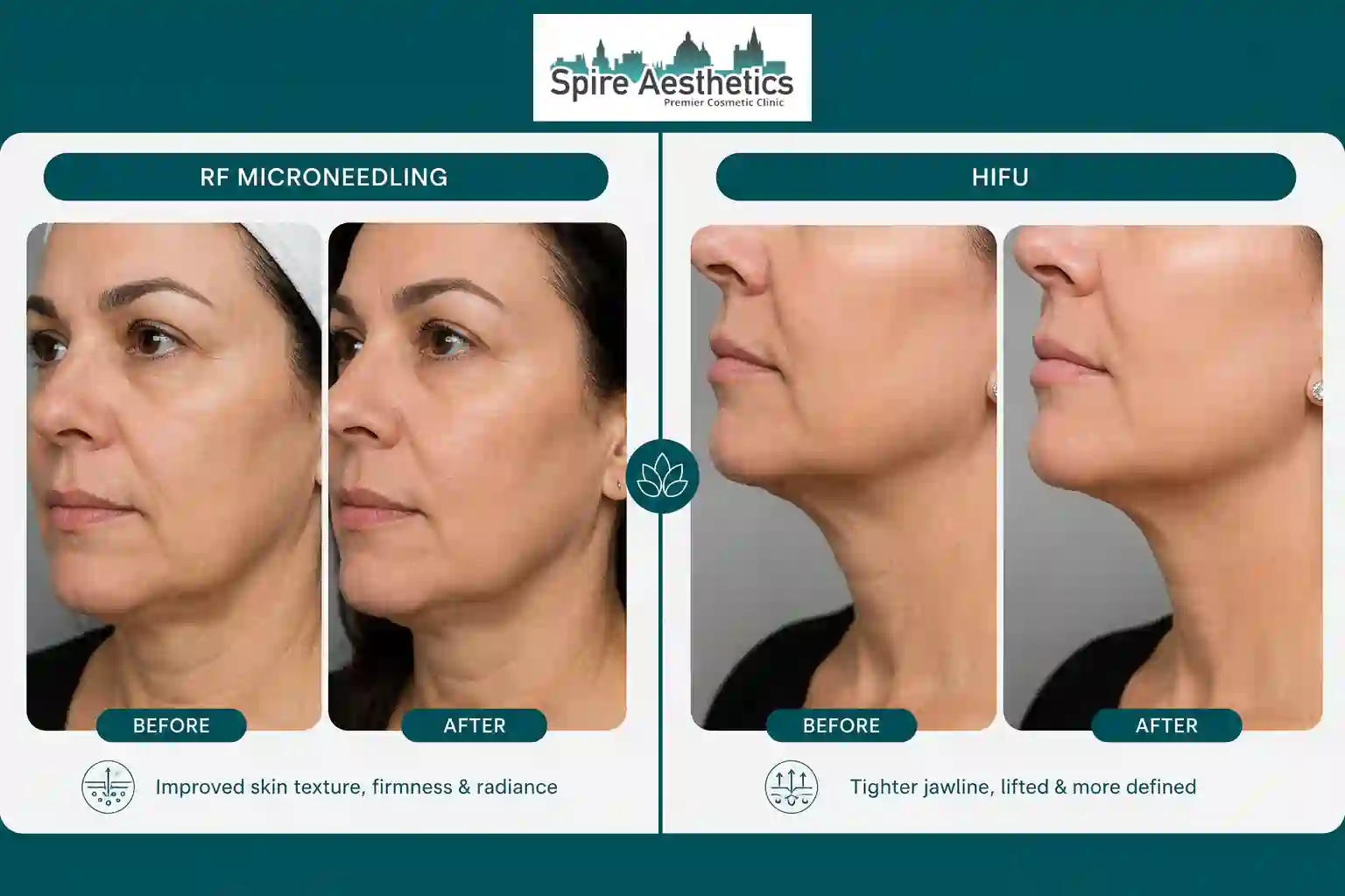 Can RF Microneedling and HIFU Be Combined Llanelli?