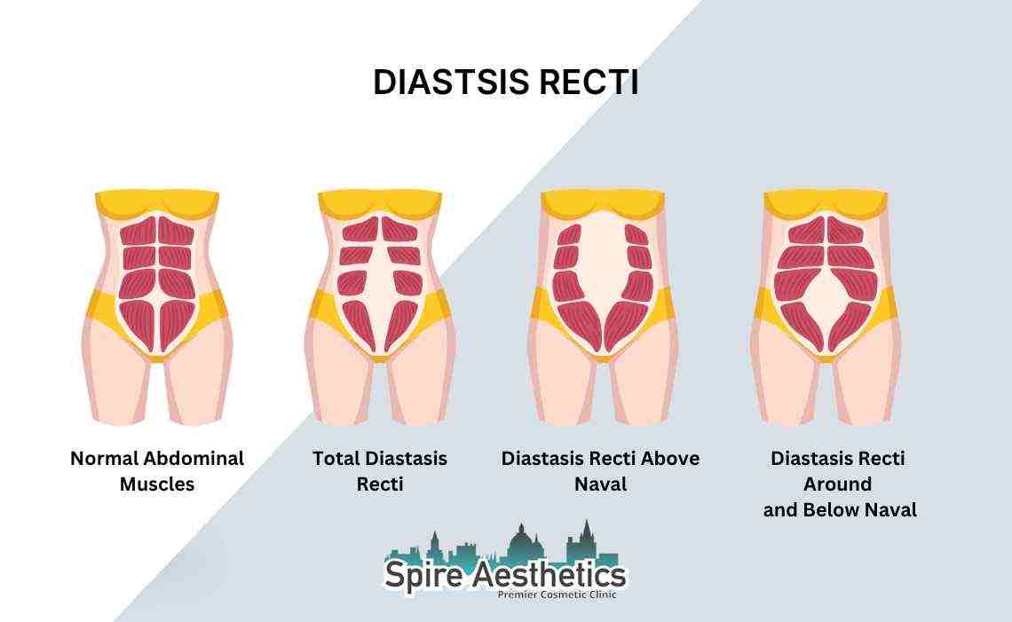 Is Non-Surgical Diastasis Recti Treatment Right for You? Common Concerns Answered Llanelli